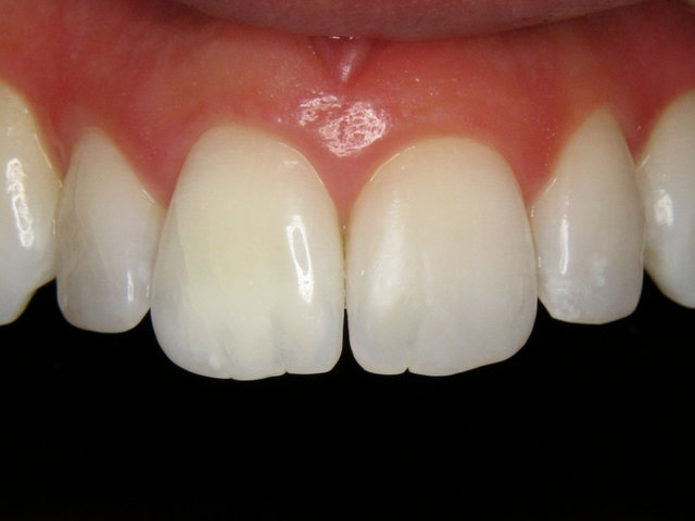 Bleaching by CLINICDENT ✓