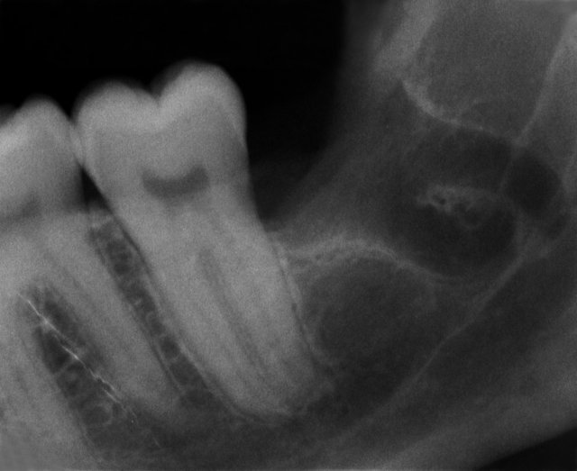 Komplikationslose Entfernung ✓