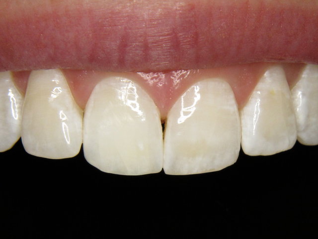 Composit-Füllung und Bleaching by CLINICDENT ✓