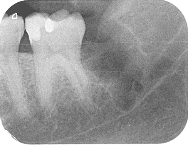 Komplikationslose Entfernung ✓