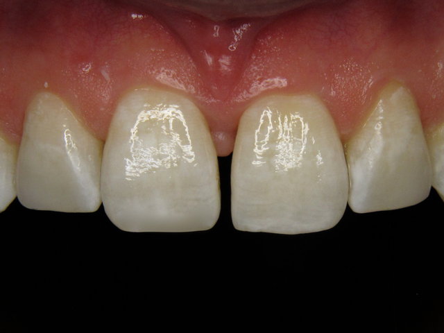 Composit-Füllungen by CLINICDENT ✓