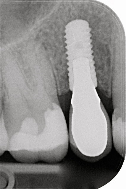 Implantat by CLINICDENT ✓