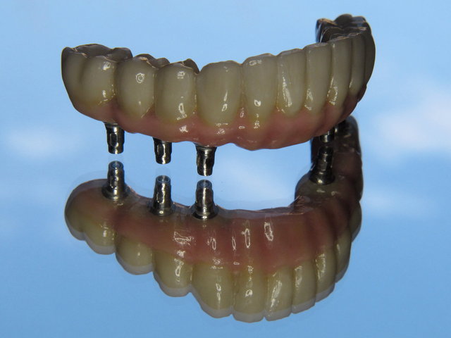 Implantatbrücke by CLINICDENT ✓