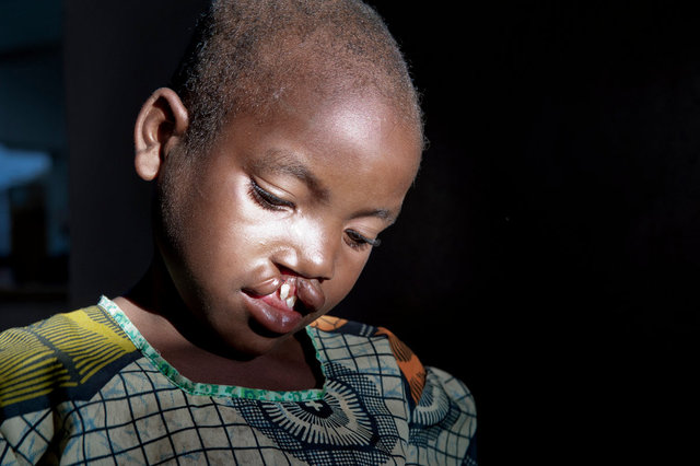 Malawi, Georgina before surgery