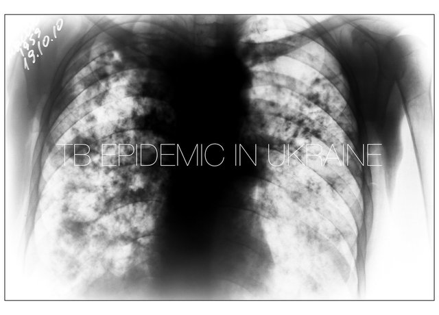 TB epidemic in Ukraine.001.jpeg