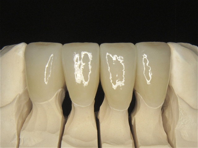 Vollkeramik-Kronen by CLINICDENT ✓