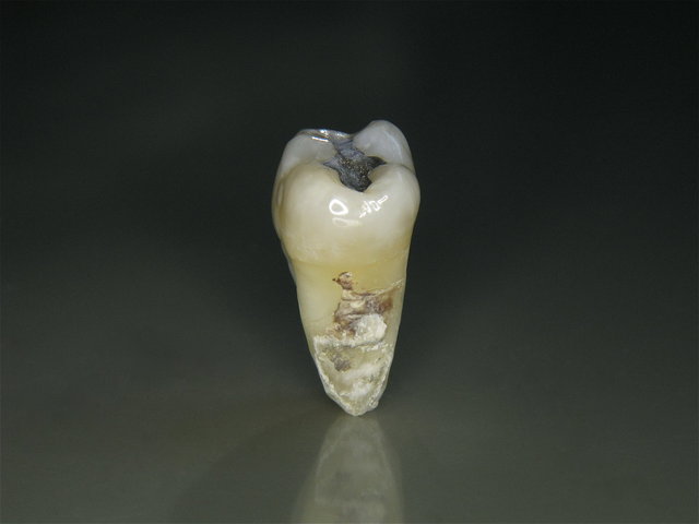 Zahnstein führt zum Zahnverlust ...