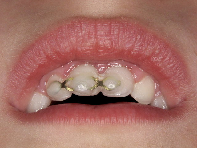 Reponierter und geschienter Milchzahn ✓