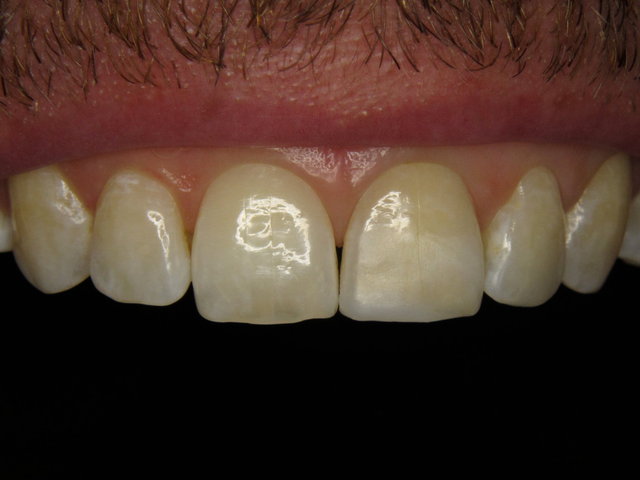 Composit-Füllungen by CLINICDENT ✓