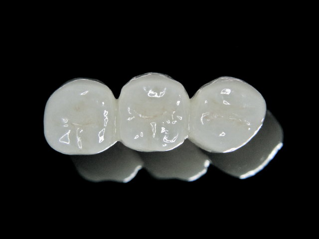 Metallfreie Vollkeramik-Brücke by CLINICDENT ✓