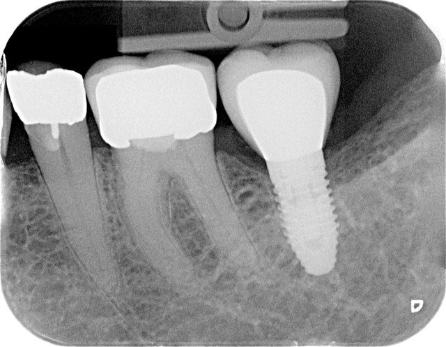 Implantat by CLINICDENT ✓