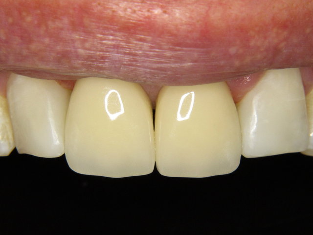 Composit-Füllungen by CLINICDENT ✓