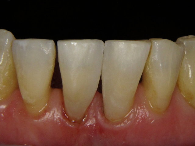 Composit-Füllungen by CLINICDENT ✓
