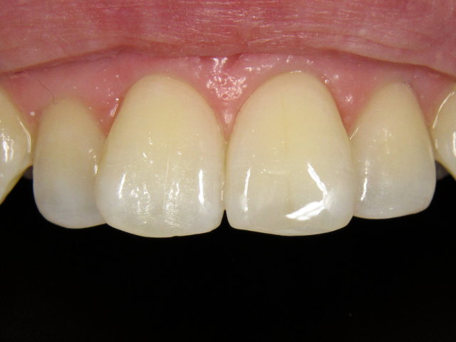 Composit-Füllung by CLINICDENT ✓