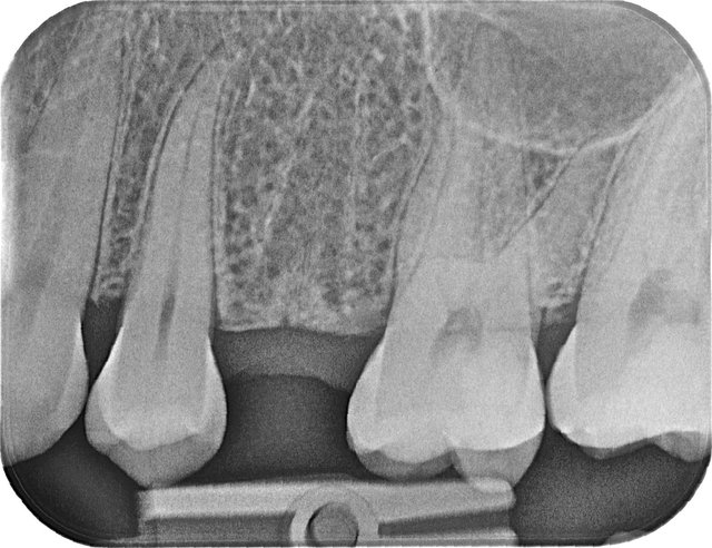 Fehlender Zahn im Röntgenbild ...