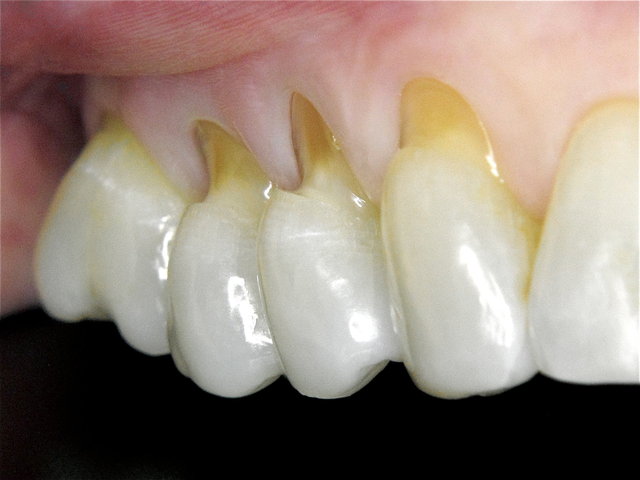 Gesunde Gingiva nach Dentalhygiene by CLINICDENT ✓