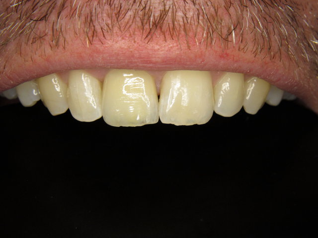 Implantatkrone by CLINICDENT ✓