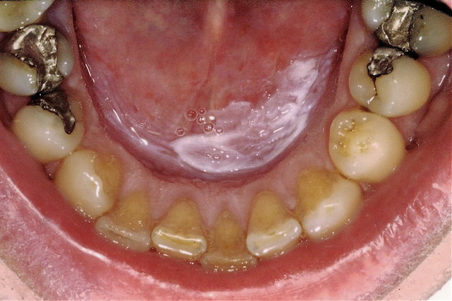 Weissliche Schleimhautveränderung im Mundboden ... (Raucher)
