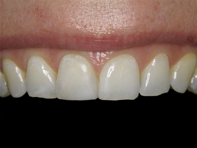 Composit-Eckaufbau by CLINICDENT ✓