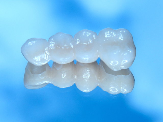 Metallfreie Vollkeramik-Brücke by CLINICDENT ✓