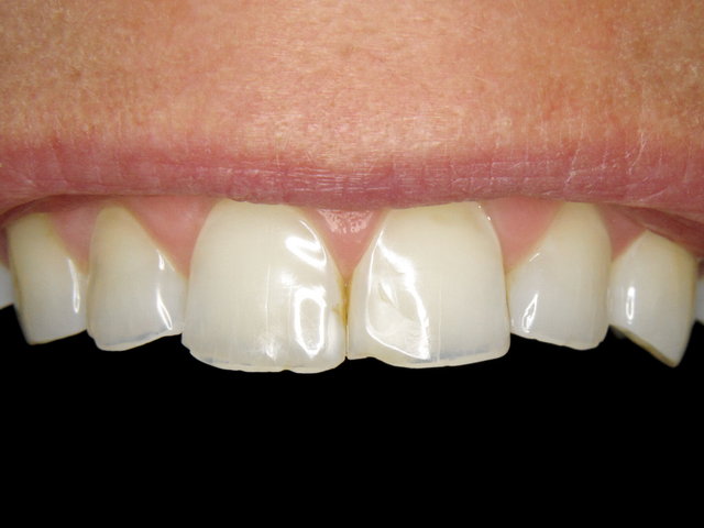 Säuregeschädigte Zähne ...