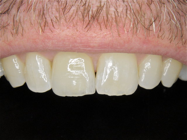 Implantatkrone by CLINICDENT ✓
