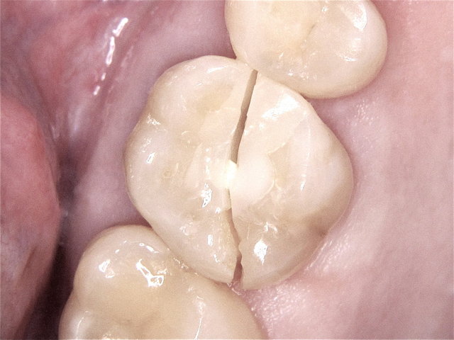 Zahnspaltung in zwei Hälften durch die Compositüllung ...