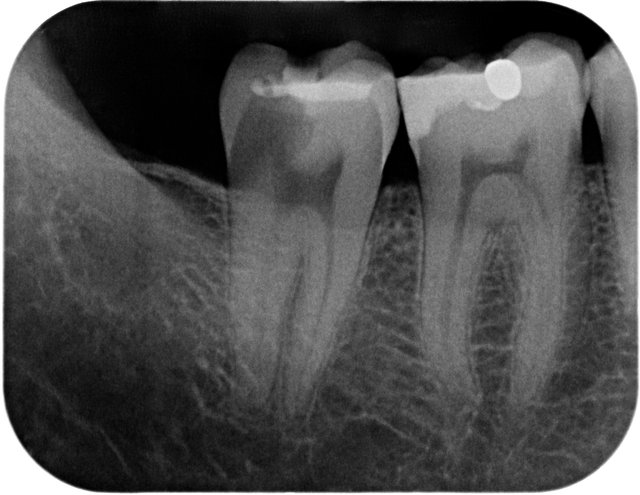 Karies infolge eines zuvor entfernten Weisheitszahnes ...