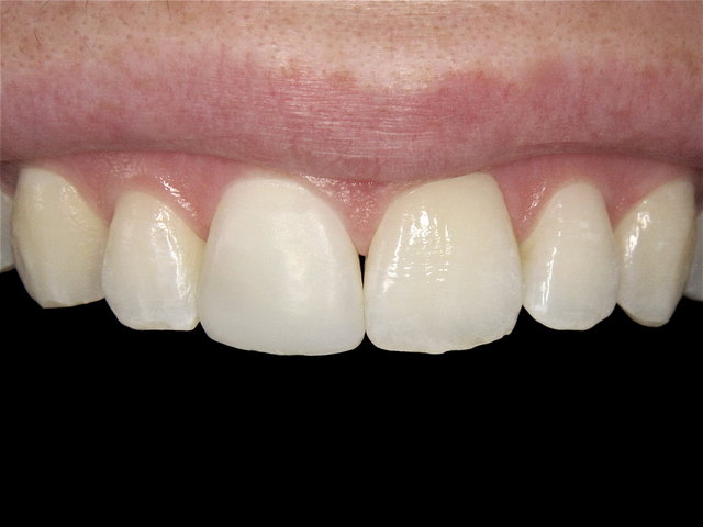 Composit-Erneuerung by CLINICDENT ✓