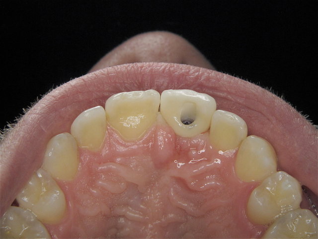 Eingeschraubte Implantatkrone by CLINICDENT ✓