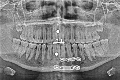 Orthopantomographie nach Unfall