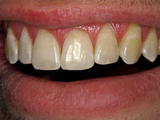 Composit-Füllungen by CLINICDENT ✓