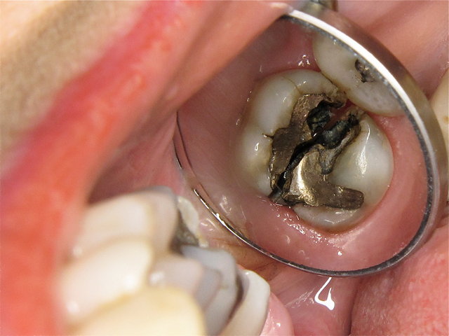 Zahnspaltung in zwei Hälften durch die Amalgamfüllung ...