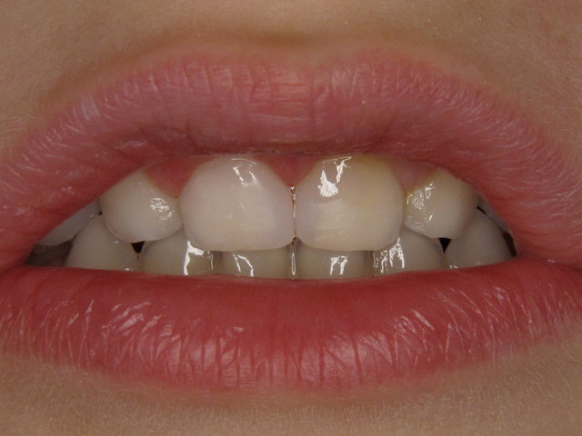 Composit-Füllungen by CLINICDENT ✓