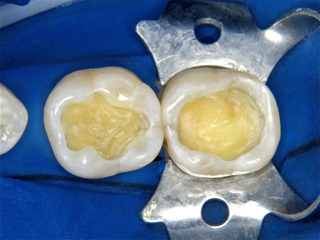 Entfernung der alten Füllungen ...