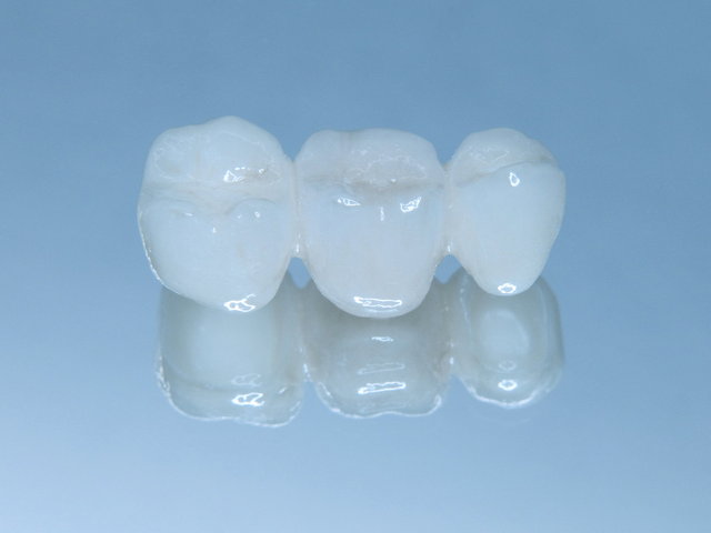 Metallfreie Vollkeramik-Brücke by CLINICDENT ✓