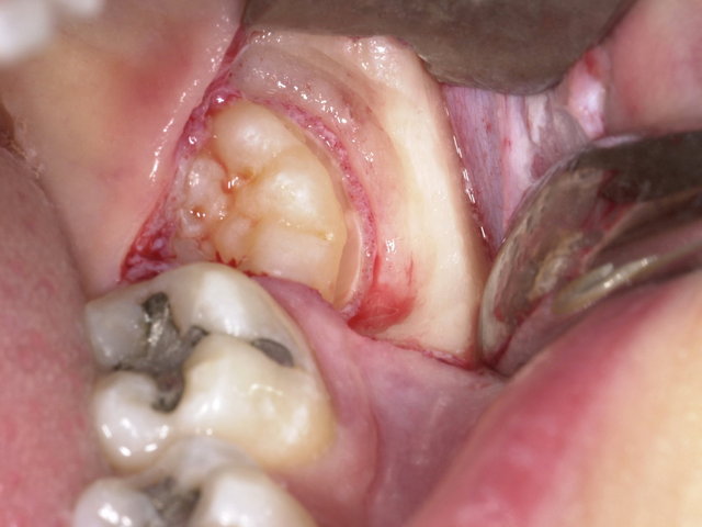 Operative Weisheitszahn-Entfernung ... ✓