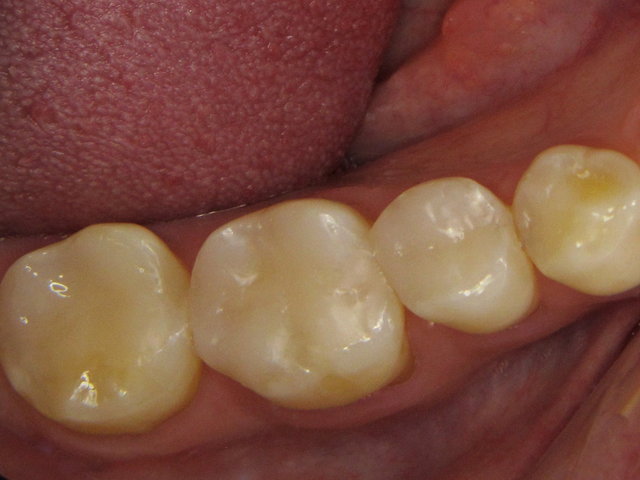 Composit-Füllungen by CLINICDENT ✓