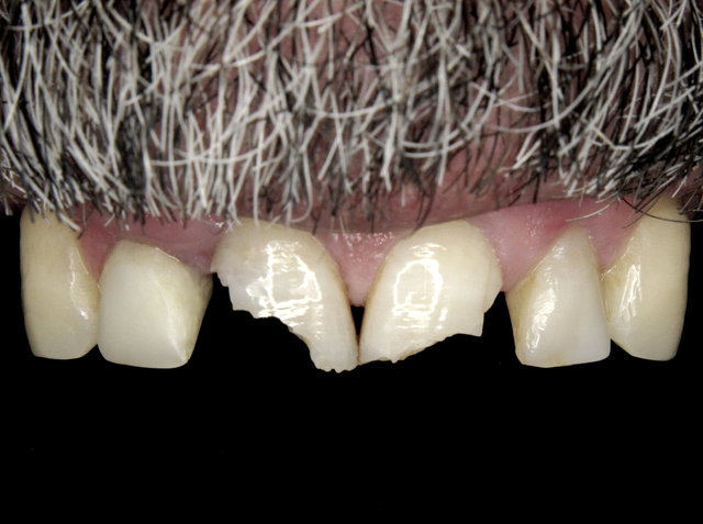 Zahnfrakturen beider mittleren Scheidezähne ...