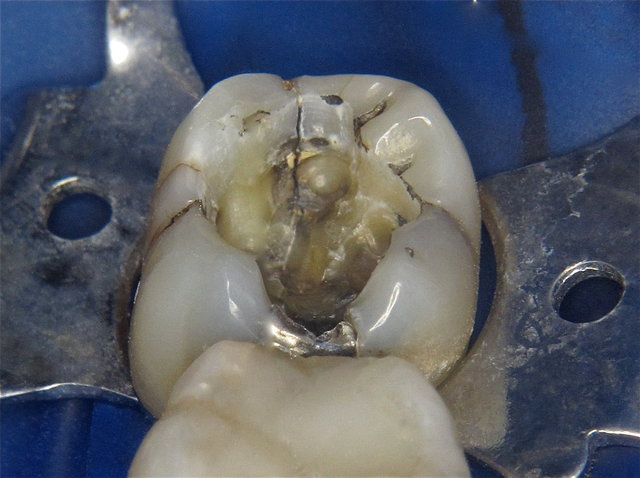 Infrakturlinien (Riss) nach Amalgam-Entfernung