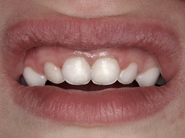Abgeheiltes Resultat by CLINICDENT ✓