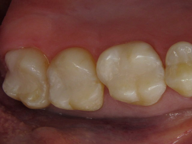 Composit-Füllungen by CLINICDENT ✓
