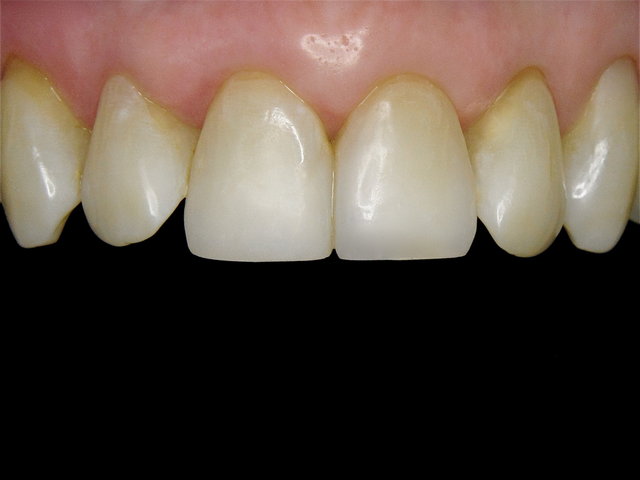 Composit-Aufbau by CLINICDENT ✓