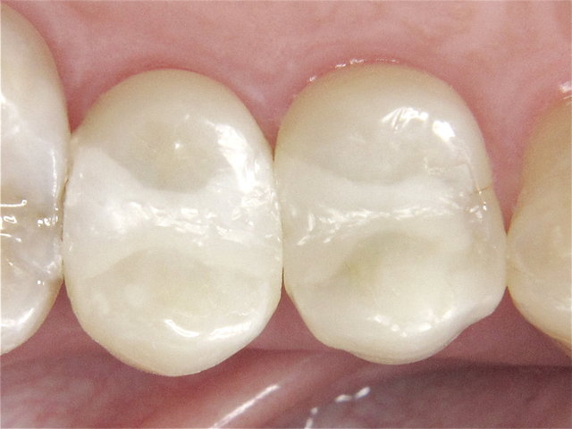 Composit-Füllungen by CLINICDENT ✓