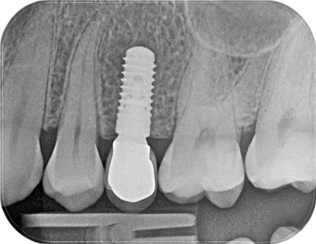 Implantat by CLINICDENT ✓