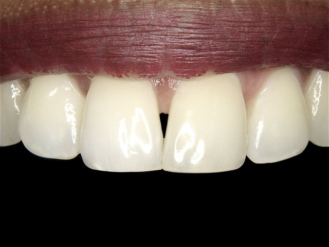 Gekürzte Schneidekante by CLINICDENT ✓