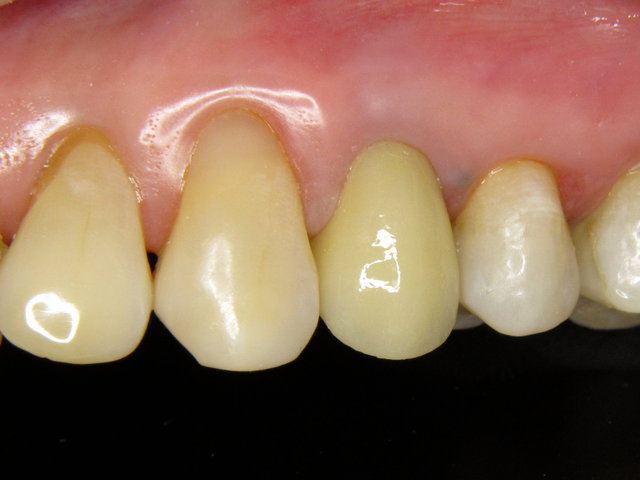 Composit-Füllungen und Vollkeramik-Krone by CLINICDENT ✓