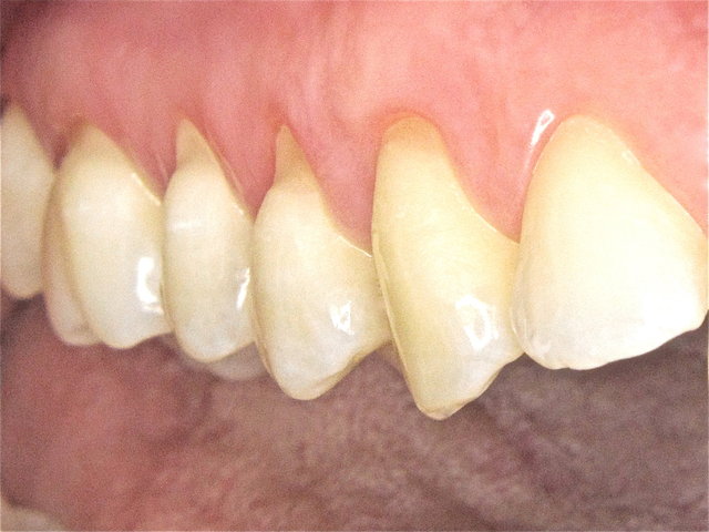 Empfindliche Zahnhals-Putzdefekte ...