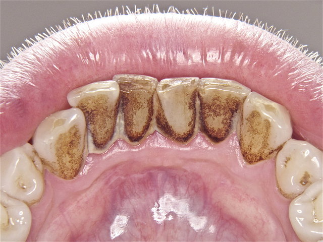 Unterkieferfront als 1. Riskostelle für rasche Zahnsteinbildung ...