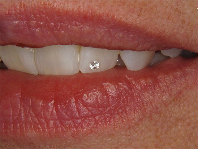 Swarovski by CLINICDENT ✓